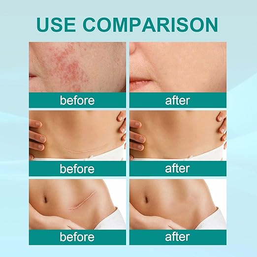 South Moon Medical Grade Scar Spray – Silicone Scar Care Spray for Old & New Scars | 20g Arbish Store