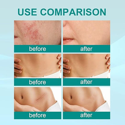 South Moon Medical Grade Scar Spray – Silicone Scar Care Spray for Old & New Scars | 20g Arbish Store